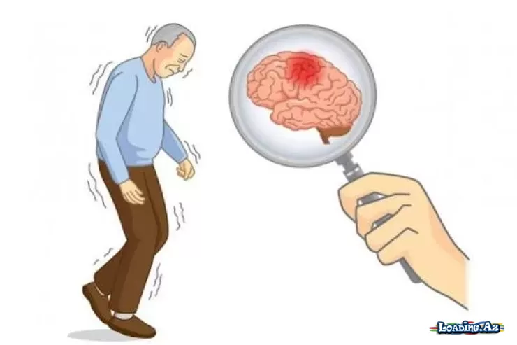 Parkinson xəstəliyi beyində belə yayılırmış - Take.Az